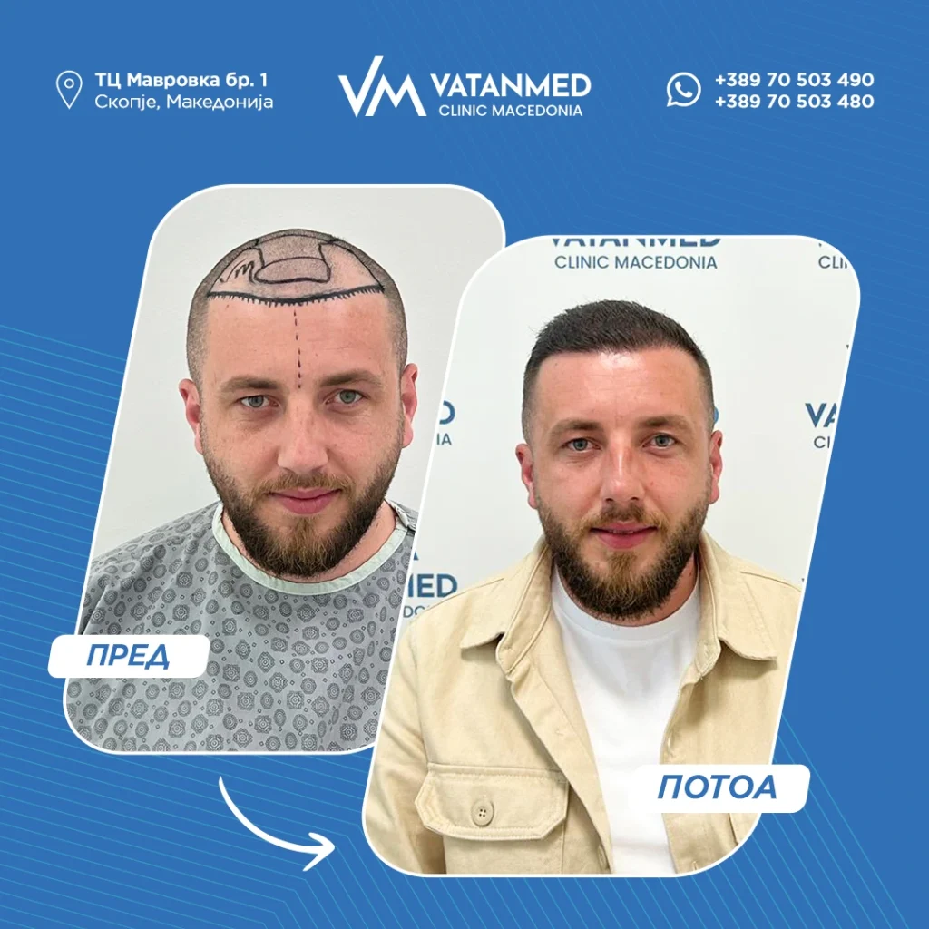 Резултат на трансплантација на коса во Vatanmed.