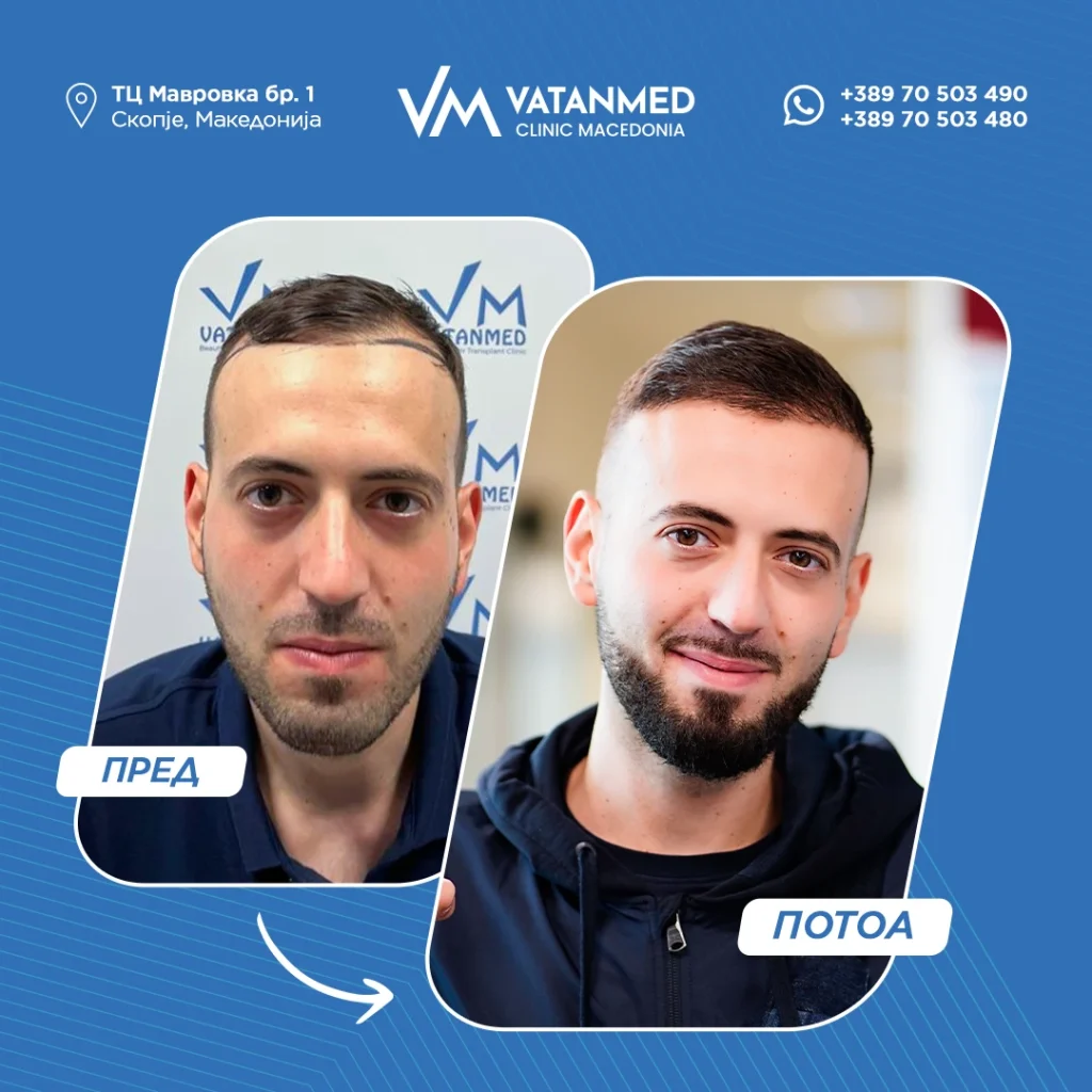 Резултат на трансплантација на коса во Vatanmed.