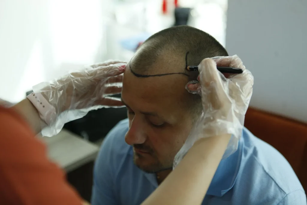 Трансплантација на коса во Vatanmed.